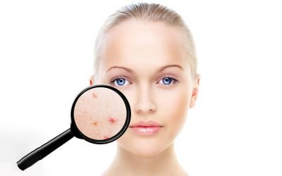 Você realmente sabe tudo sobre acne?
