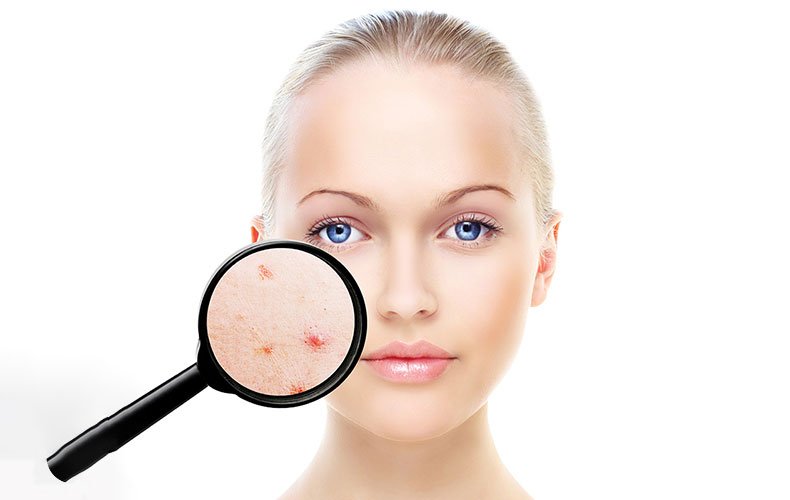 Você realmente sabe tudo sobre acne?