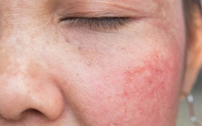 Características da Rosácea