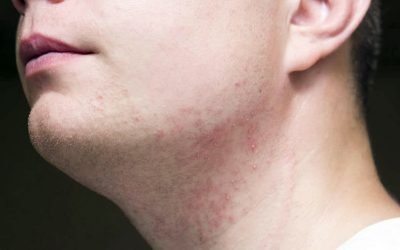 Você sabe o que é Foliculite?