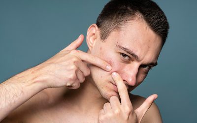 A Alimentação tem Interferência Direta na Acne?